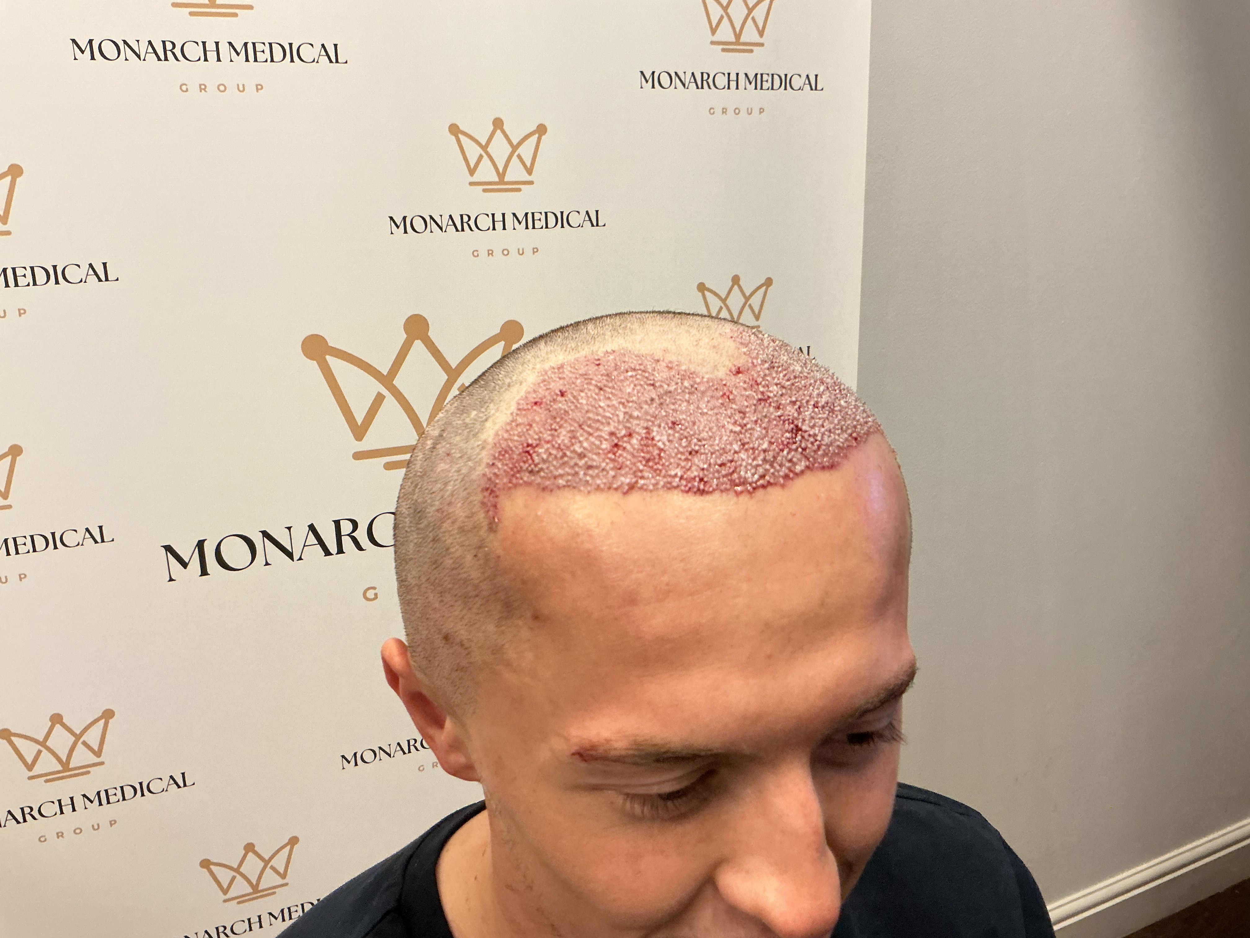 Advanced hairline recession — result photo 7